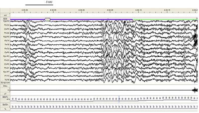 Commonalities and Differences in NREM Parasomnias and Sleep-Related Epilepsy: Is There a Continuum Between the Two Conditions?